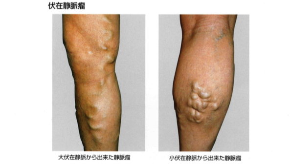 下肢静脈瘤とは？