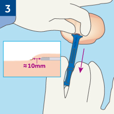 3.切開創の縫合