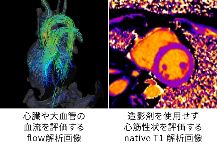 心臓や大血管の血流を評価するflow解析画像 | 造影剤を使用せず心筋性状を評価するnative T1解析画像