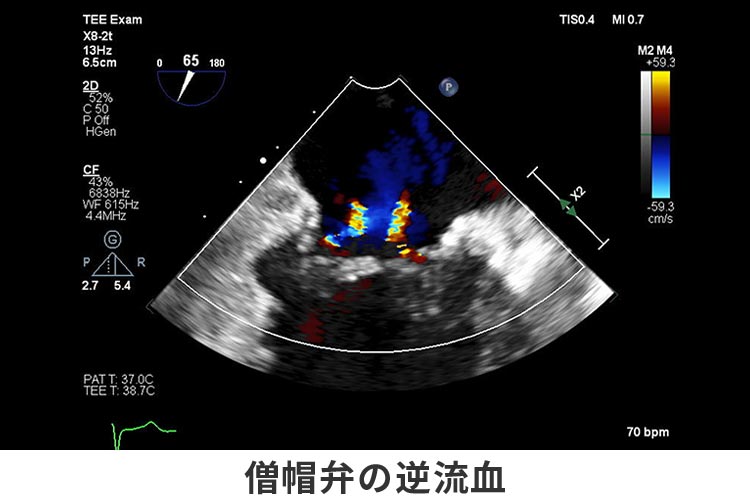 僧帽弁の逆流血の検査画像