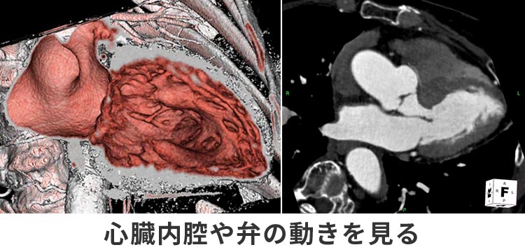 心臓内腔や弁の動きを見る