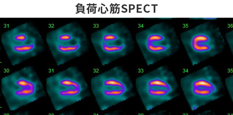 負荷心筋SPECT