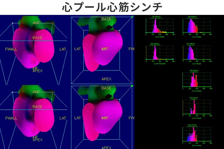 心プール心筋シンチ