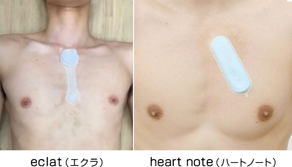 長時間ホルター（7日間）検査の様子